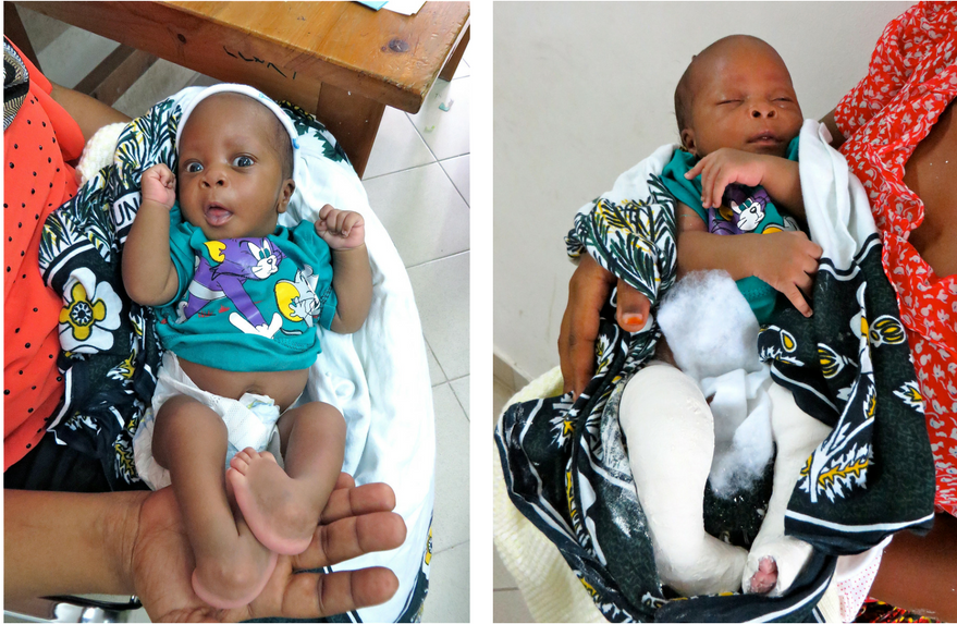 clubfoot-treatment-tanzania