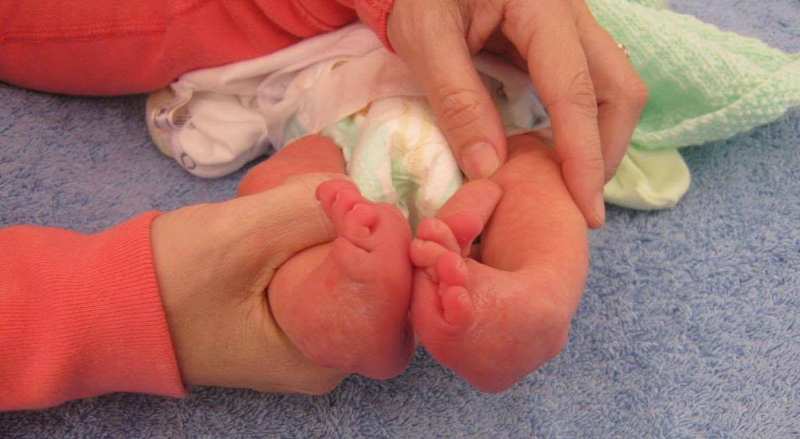 luca-clubfoot-success-story-1