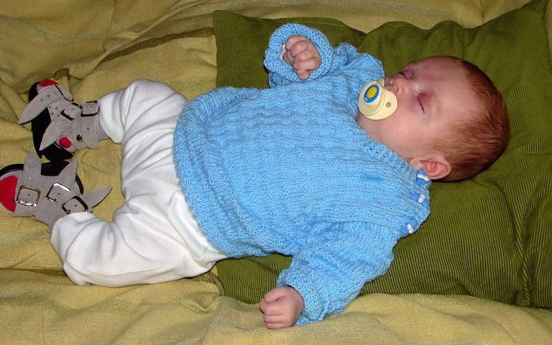 luca-clubfoot-success-story-2